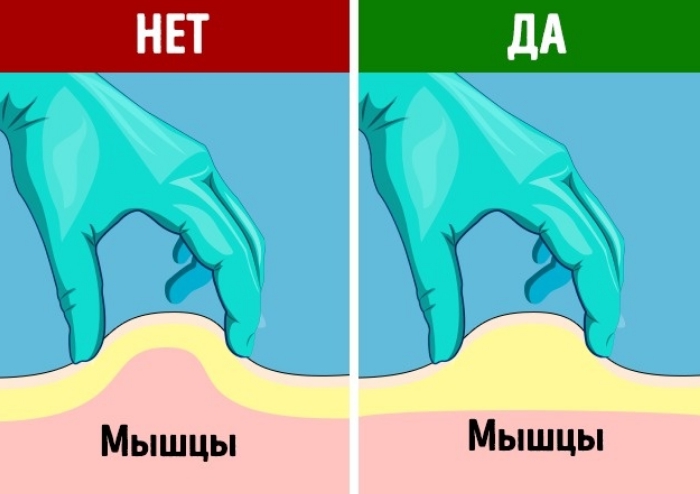 Укол в бедро внутримышечно схема