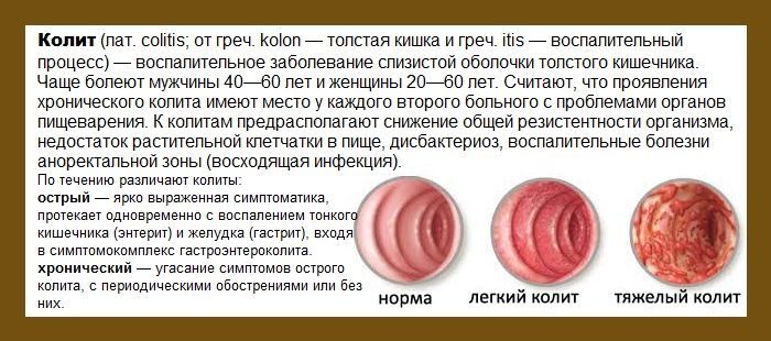 Стул при спастическом колите