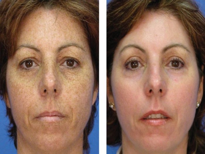 4213275_udalenie-pigmentnyh-pyaten-do-posle_3845777