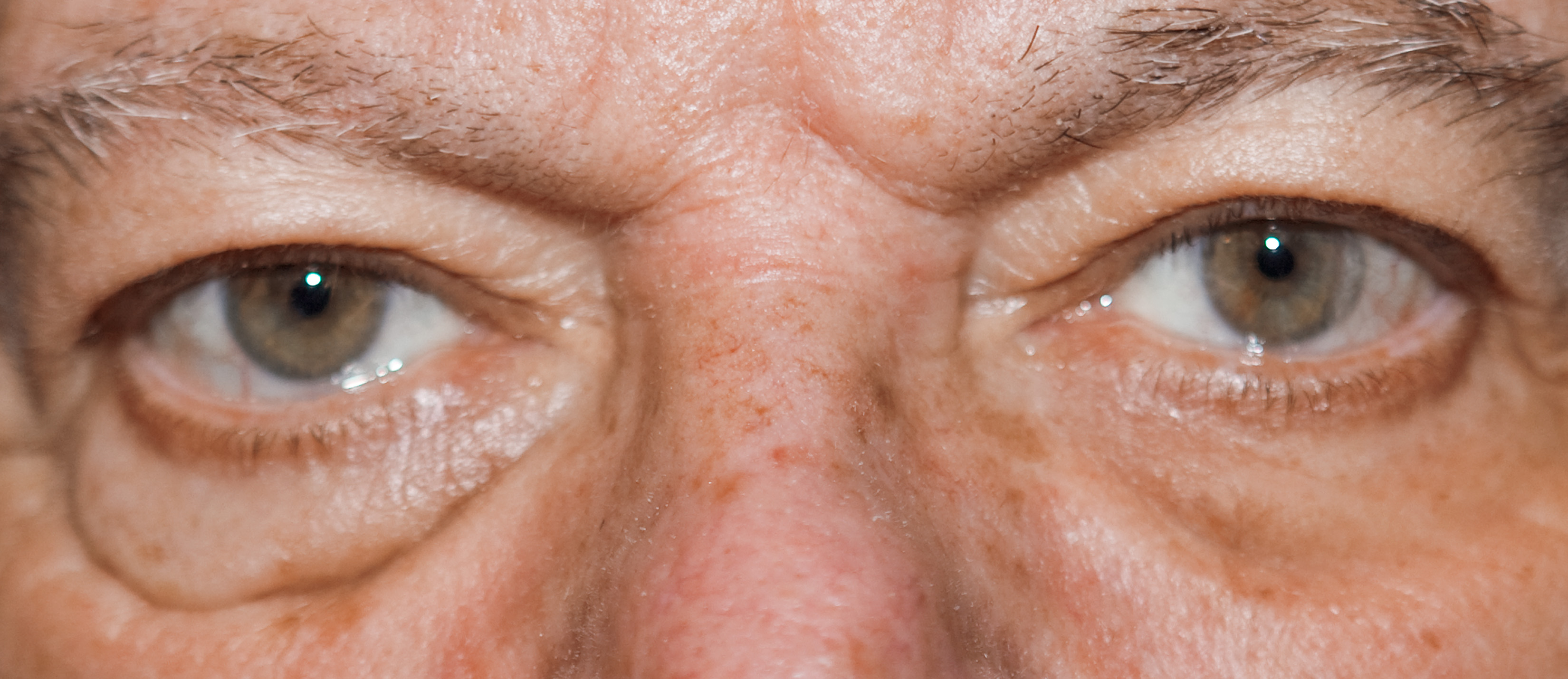 Лечение мешков под глазами у мужчин. Водянистый отек под глазом.