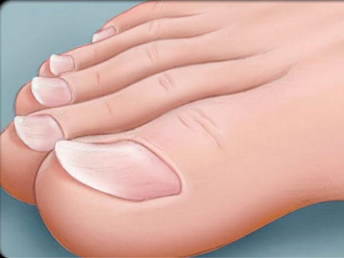 gorizontalnye-grebni