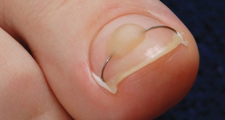 kak-lechit-vrosshij-nogot