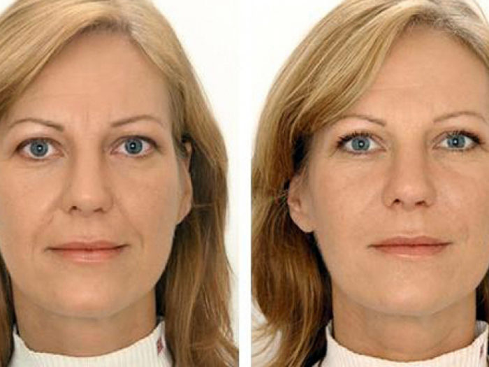 kak-vozdeistvuet-plazmolifting