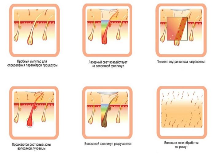 lazer-volos-epilyator-dlya-udaleniya-volos