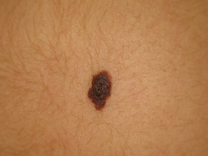 nevus