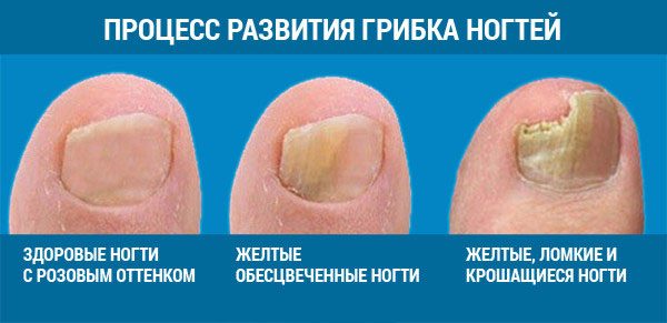 stadii-razvitiya-gribka-nogtej-600x291