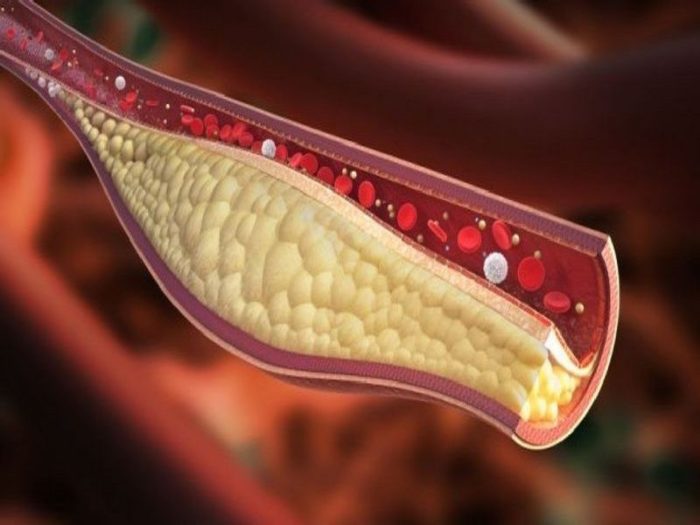 content_unclog-arteries_result__econet_ru