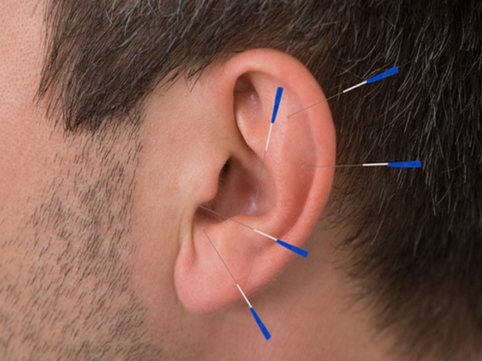 earacupuncture