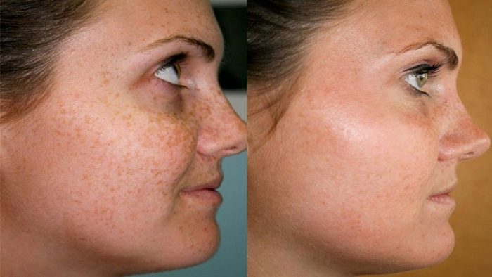 lazernoe-udalenie-vesnushek-foto-do-i-posle-11