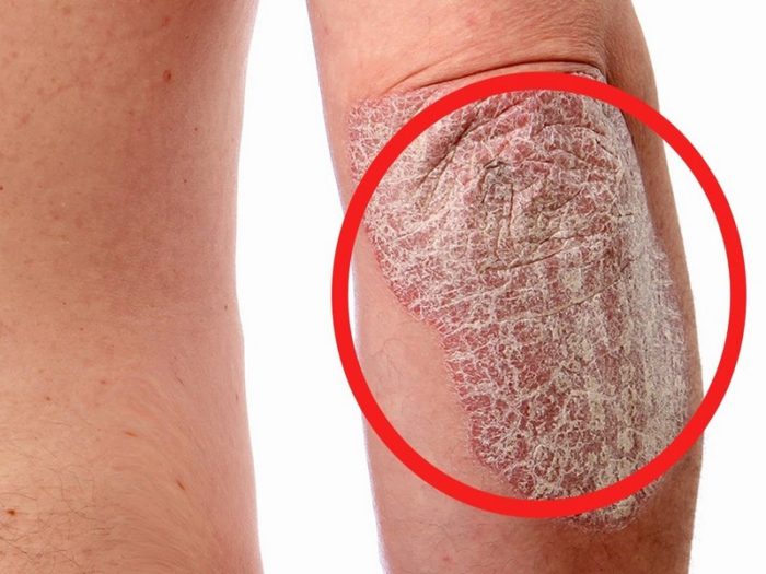 psoriaz-3