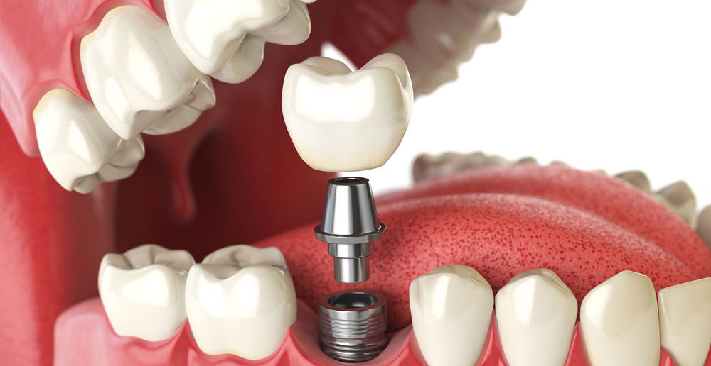 why-dental-implants