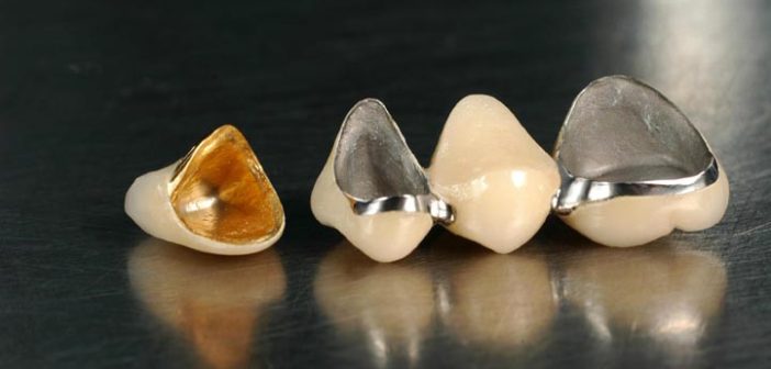 zubnye-koronki-iz-dragocennyx-metallov