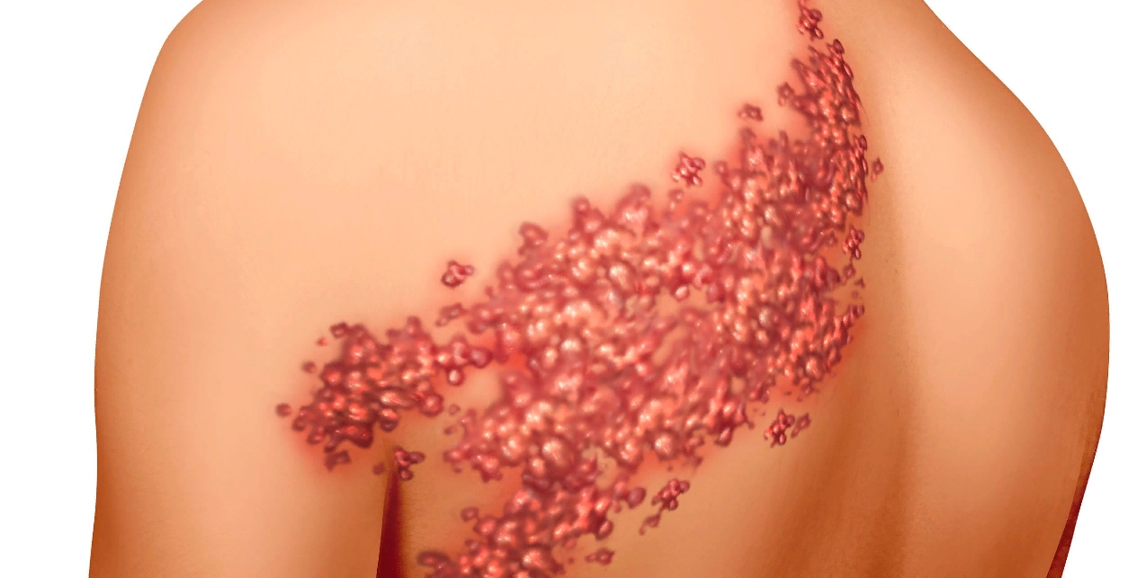кожные высыпания на груди у женщин фото 65