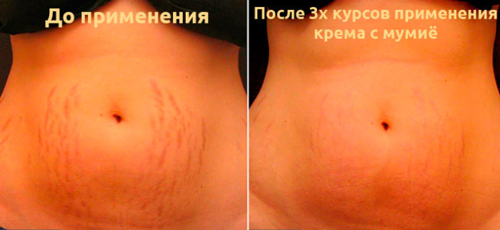 kak-primenyat-mumie-ot-rastyazhek-3