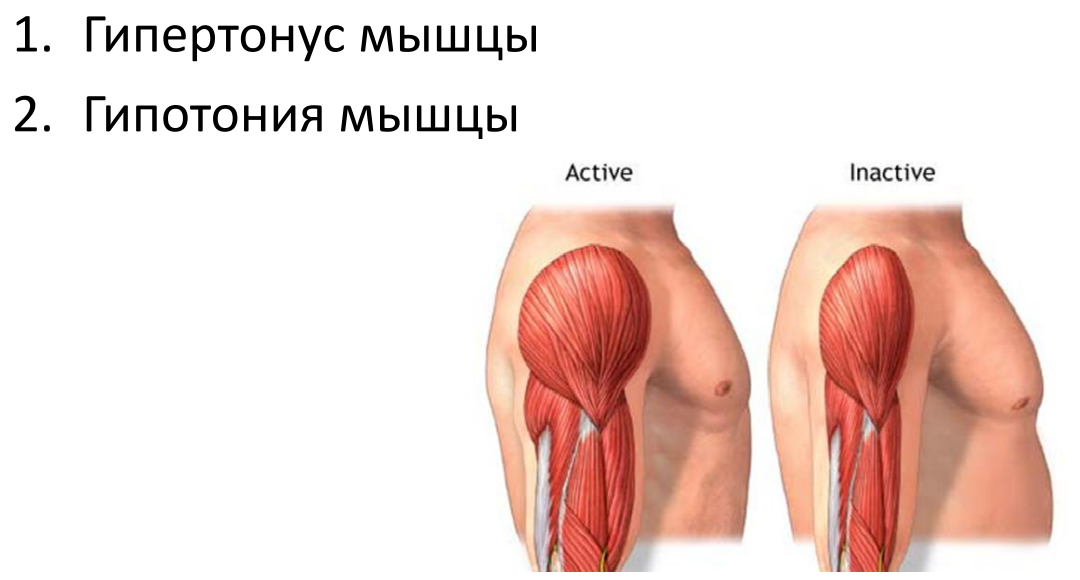 Мышечный гипертонус. Гипер мышцы. Тонус мышц. Диффузные мышцы