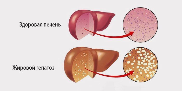 Жировой гепатоз печени картинки