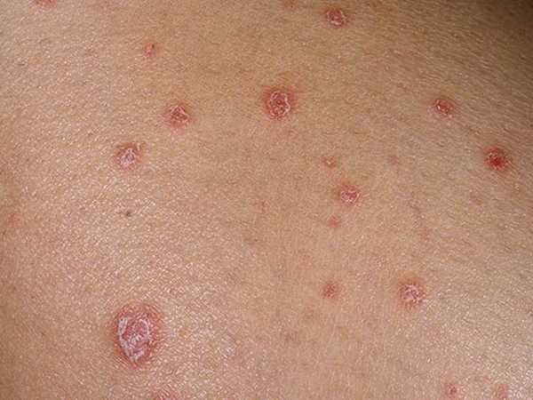 sifilis-u-zhencshiny_5