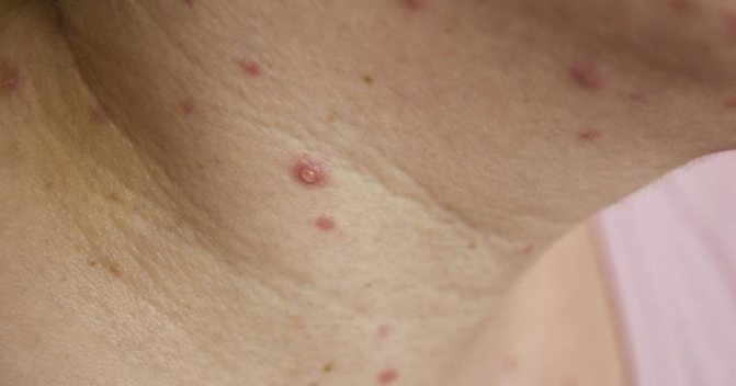 vospalitelnyj-pzshhshorpoteka