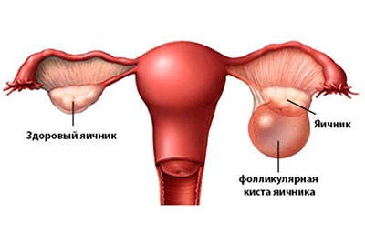 Признаки фолликулярной кисты яичника
