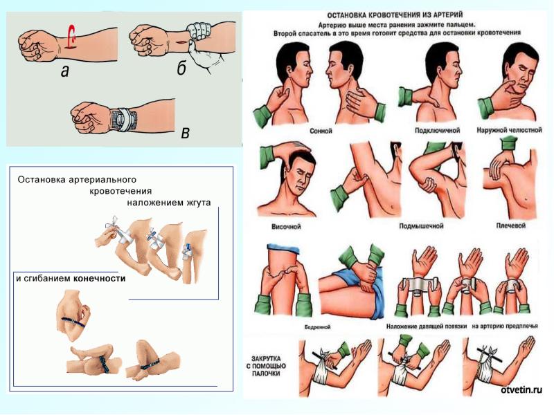 Первая медицинская помощь при кровотечениях фото