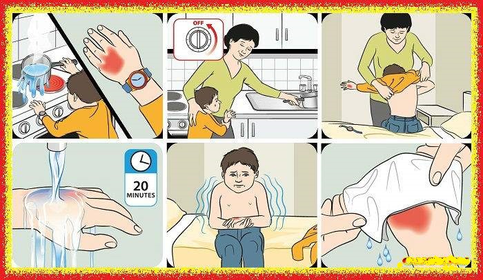 rebenok-obzheg-ruku-chto-delat